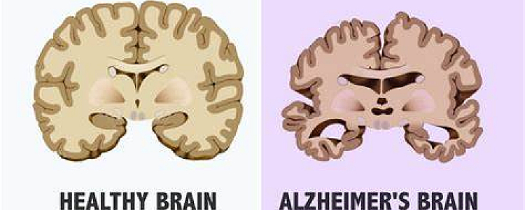 World Alzheimer