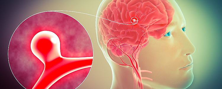 Everything About Cerebral Aneurysm: A Fatal Disease from Which Chinese President May be Suffering